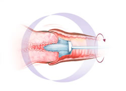 uterus31